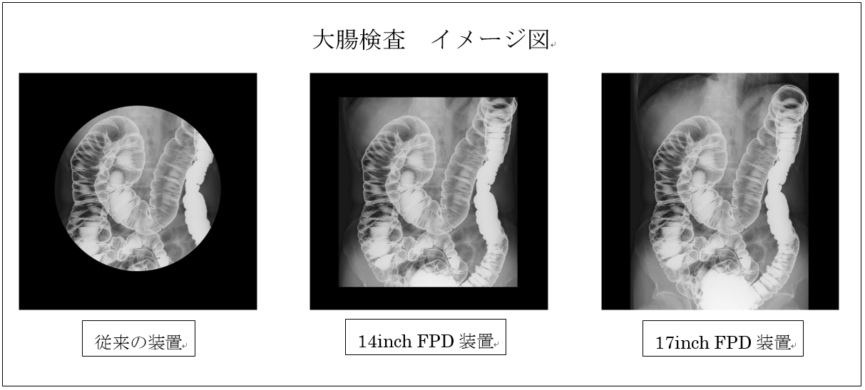 大腸検査イメージ図