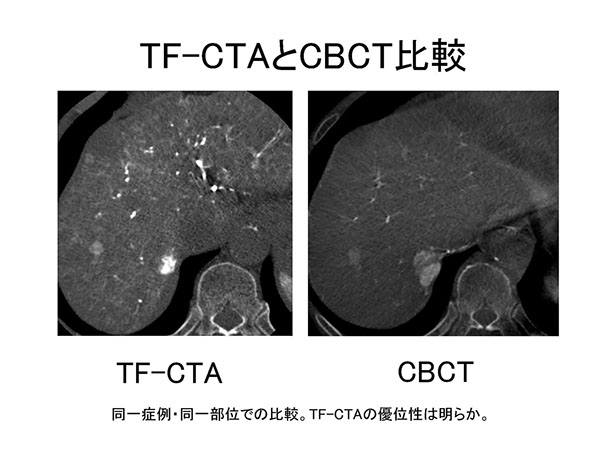 b-taceのための腫瘍栄養血管同定_ページ_22
