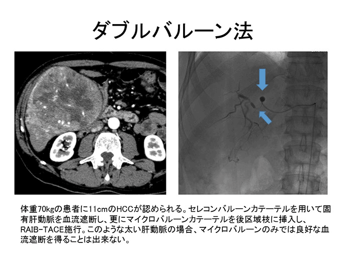 7cm超巨大結節に対するraib Tace 筑波大学附属病院水戸地域医療教育センター Ja茨城厚生連総合病院 水戸協同病院 7cm超巨大結節に対するraib Tace 筑波大学附属病院水戸地域医療教育センター Ja茨城厚生連総合病院 水戸協同病院