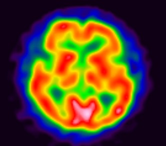 脳血流シンチ画像