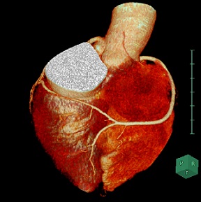 冠動脈CTA