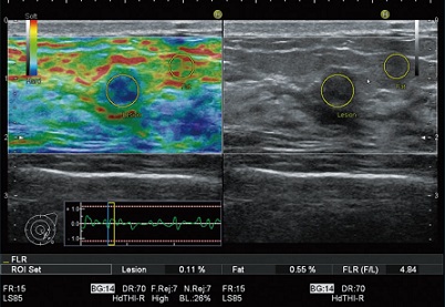 エラストグラフィー画像