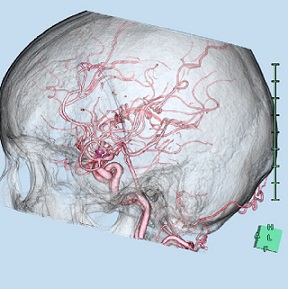 頭部CTA