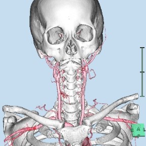 頸部CTA